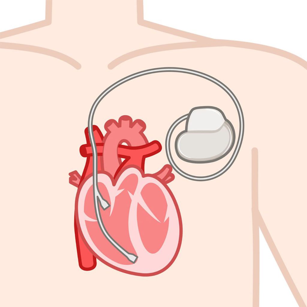 ペースメーカーを埋め込んだ心臓のイラスト