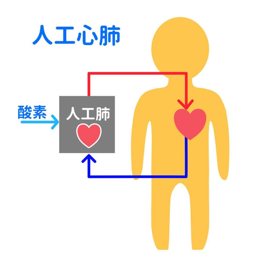 人工心肺の説明イラスト