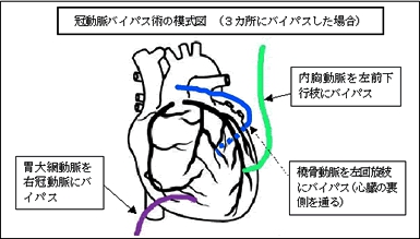 冠動脈バイパス術 Cabg とは どんな手術なのですか