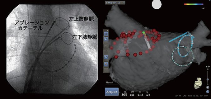 心房細動に対するカテーテルアブレーション