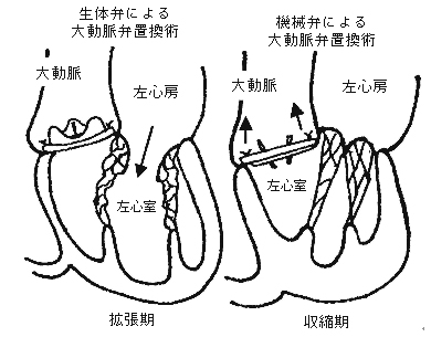 大動脈弁狭窄症