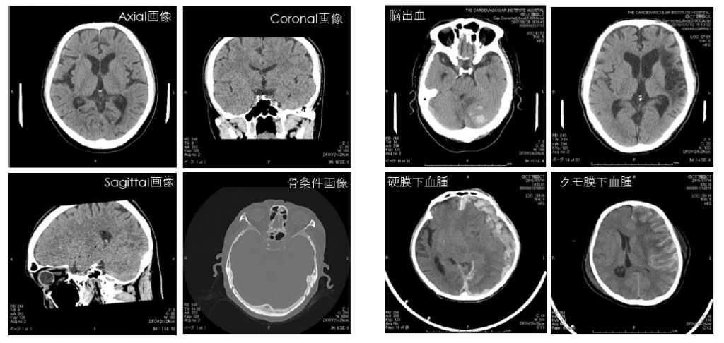 頭部CT