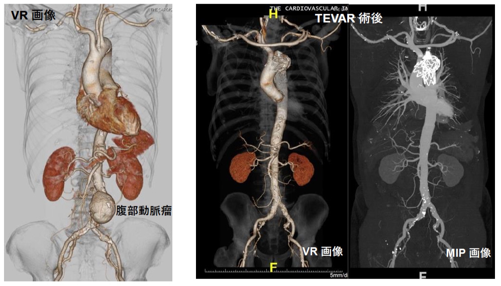 胸腹骨盤CTA